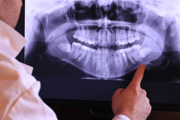 Best Emergency Treatment for Dental Infections or Abscesses in Kent, WA